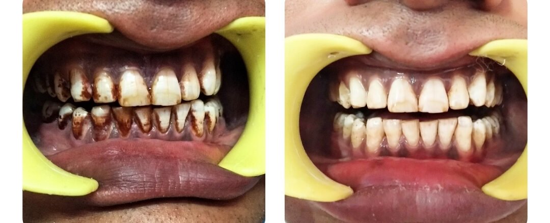 dentist in sms hospital jaipur